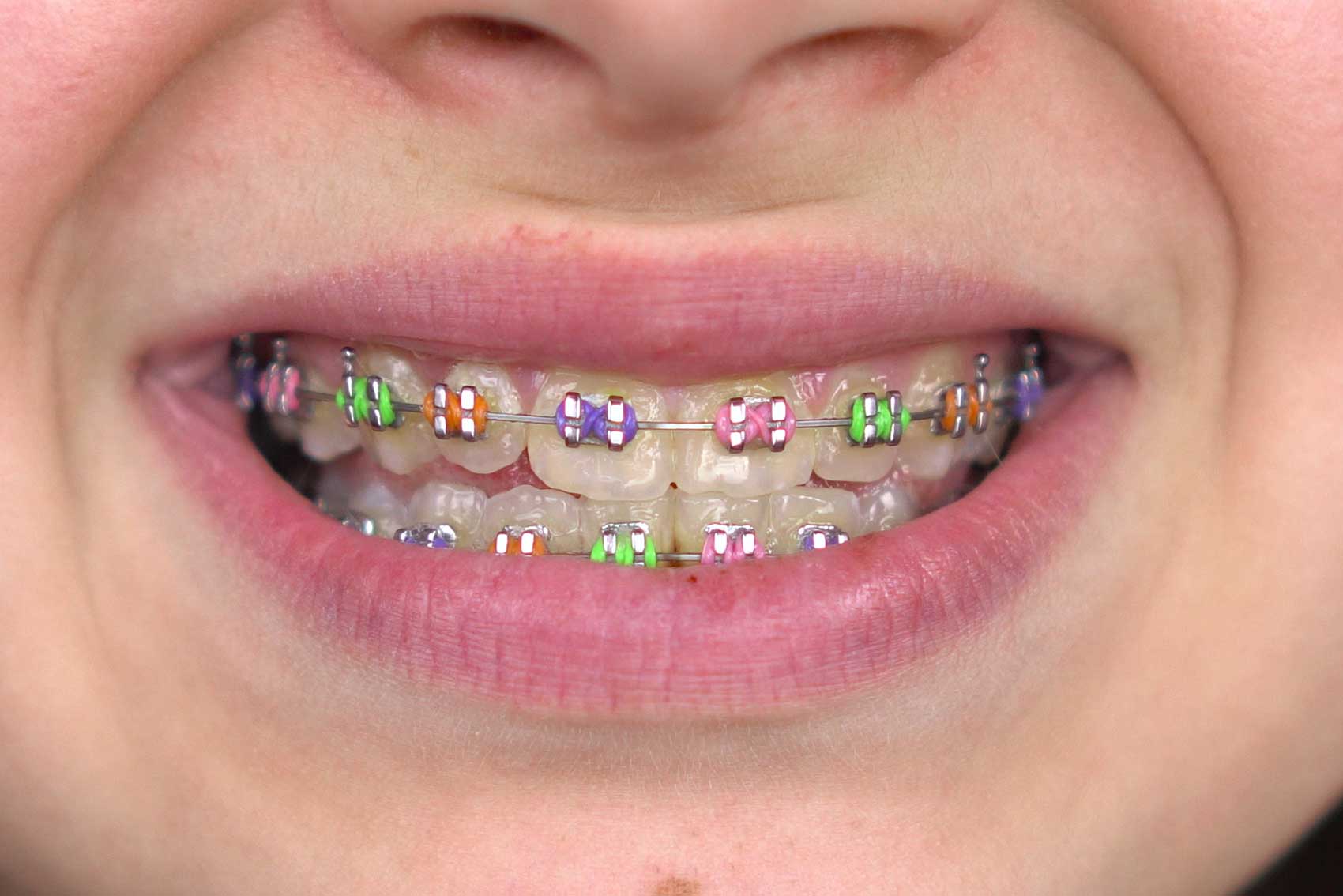 a smile of a girl wearing braces with assorted coloured rubber on each tooth