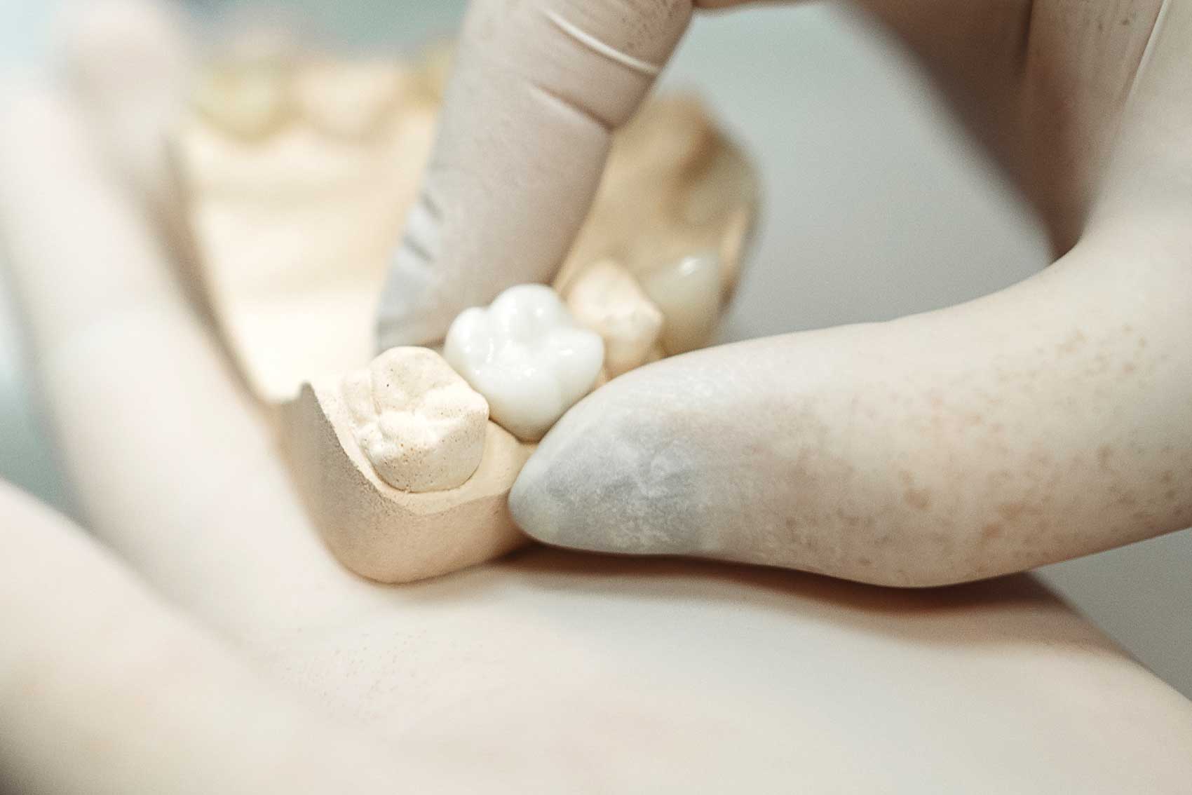 Dentist using mould of teeth set to check the size of the implant