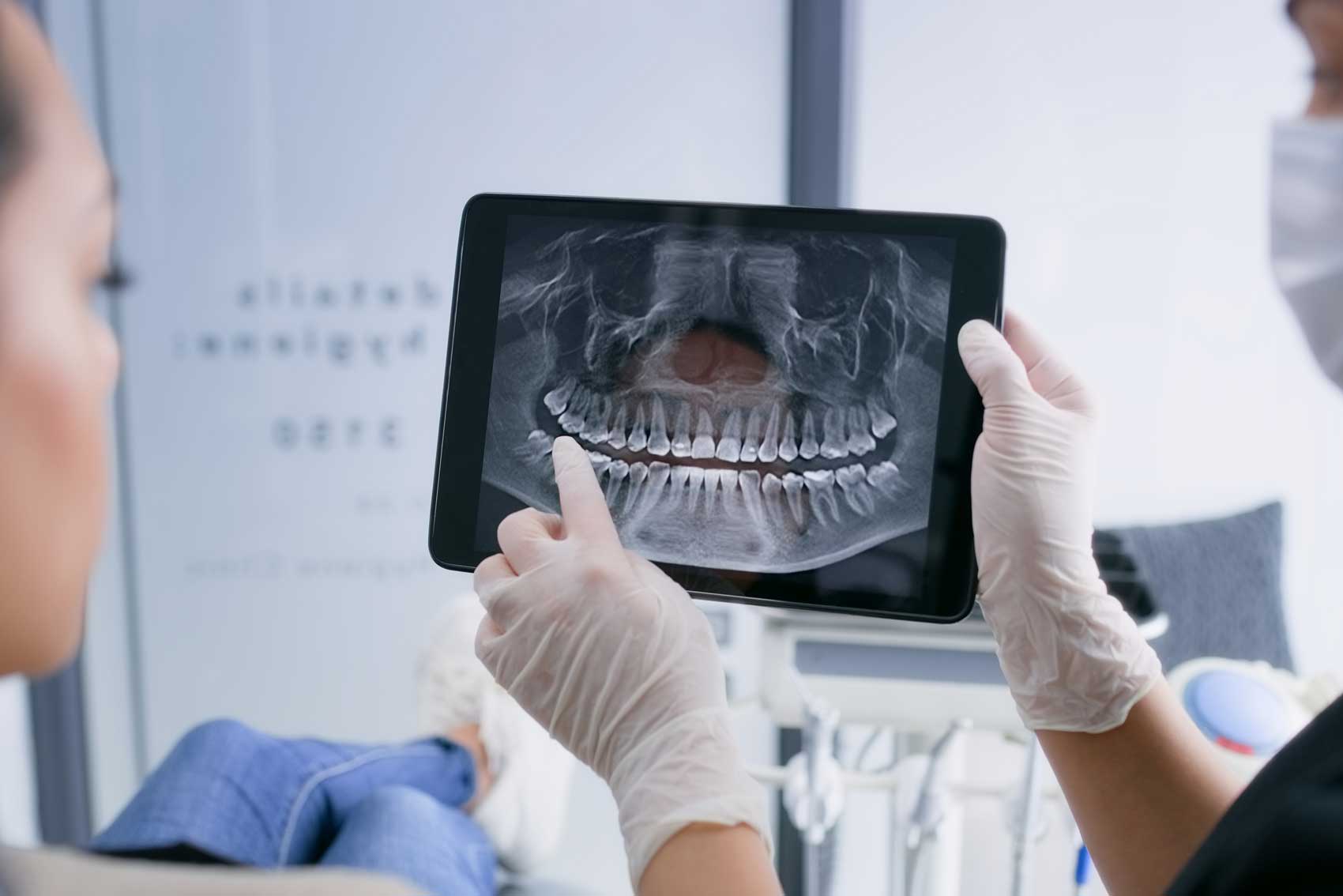 Dentist showing x-ray of teeth for dental implants