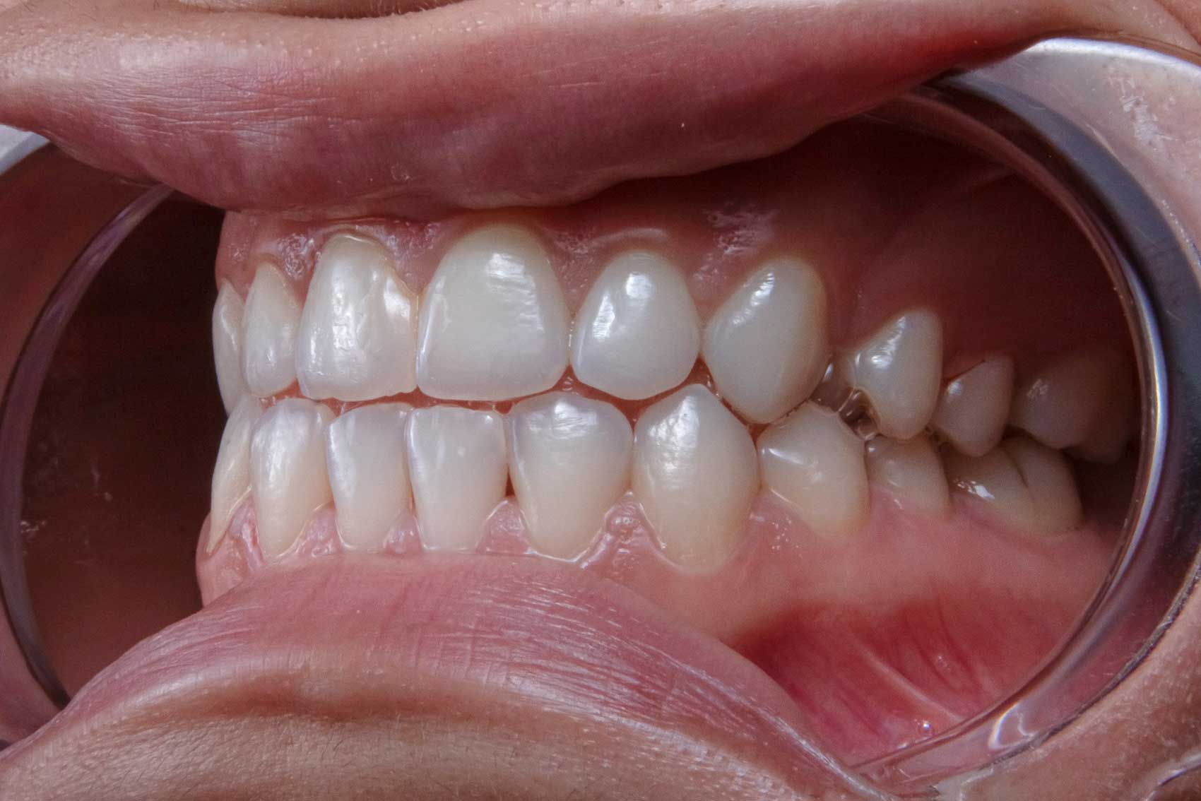 exposed gums for periodontics treatment